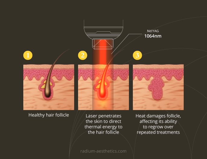 Hair Removal Laser Radium Medical Aesthetics Singapore