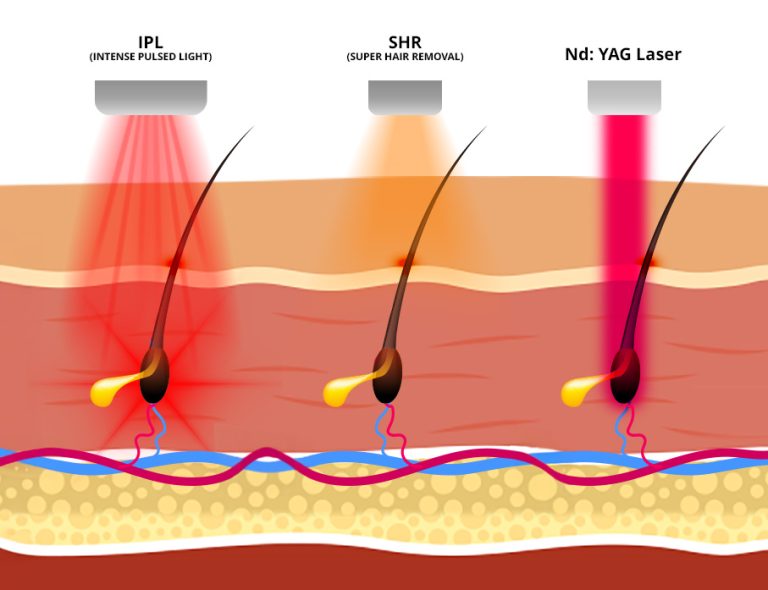 IPL vs SHR vs Laser Hair Removal