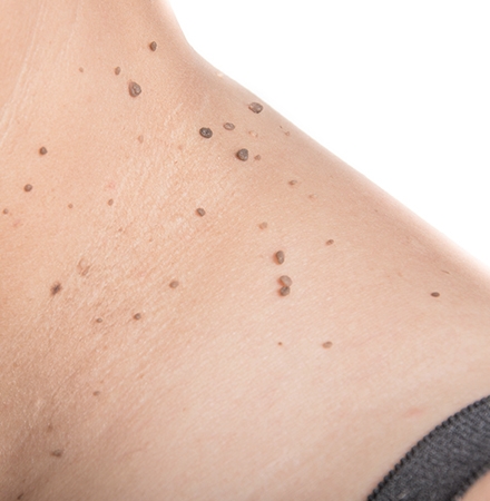 skin tags on neck removal