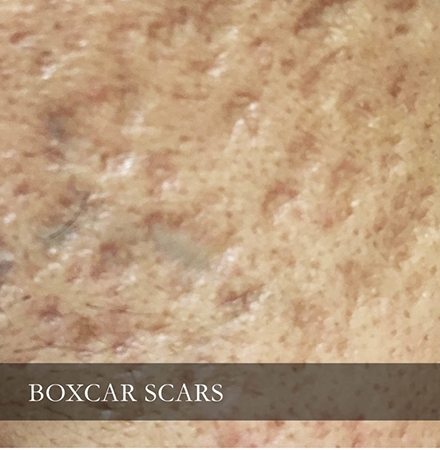 box-scar-871x1024