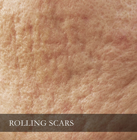 rolling-scar-871x1024