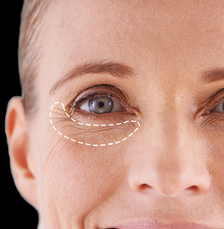 How To Reduce Fine Lines & Wrinkles Under Eyes