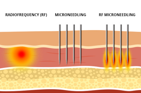 RF vs Microneedling vs RF Microneedling