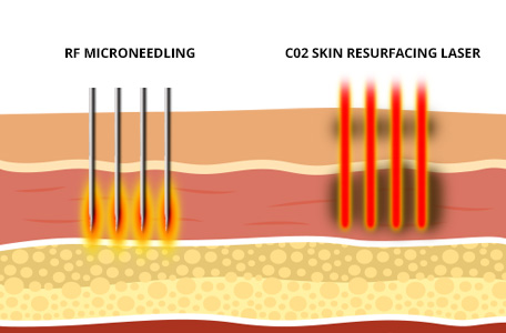 RF Microneedling vs CO2 Laser