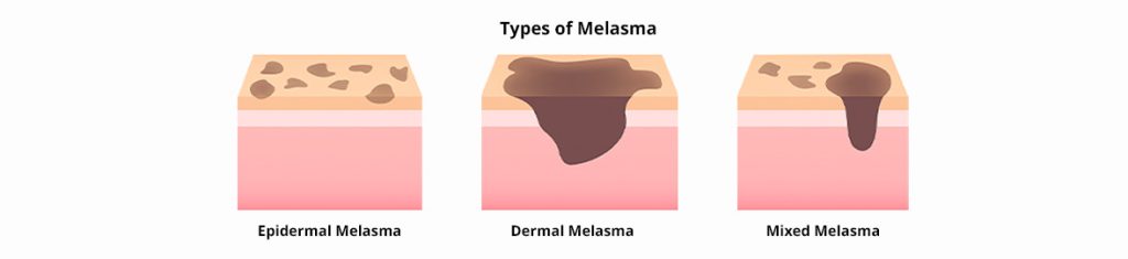Types Of Melasma