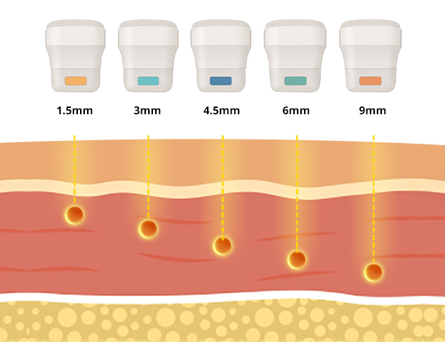 Ultraformer HIFU Treatment in Singapore