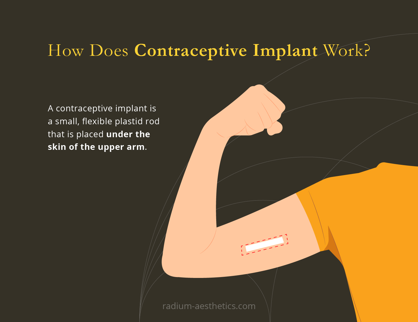 Contraceptive Implants Radium Medical Aesthetics Singapore contraceptive-implants-radium-medical-aesthetics-singapore
