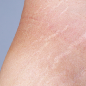 White Stretch Marks